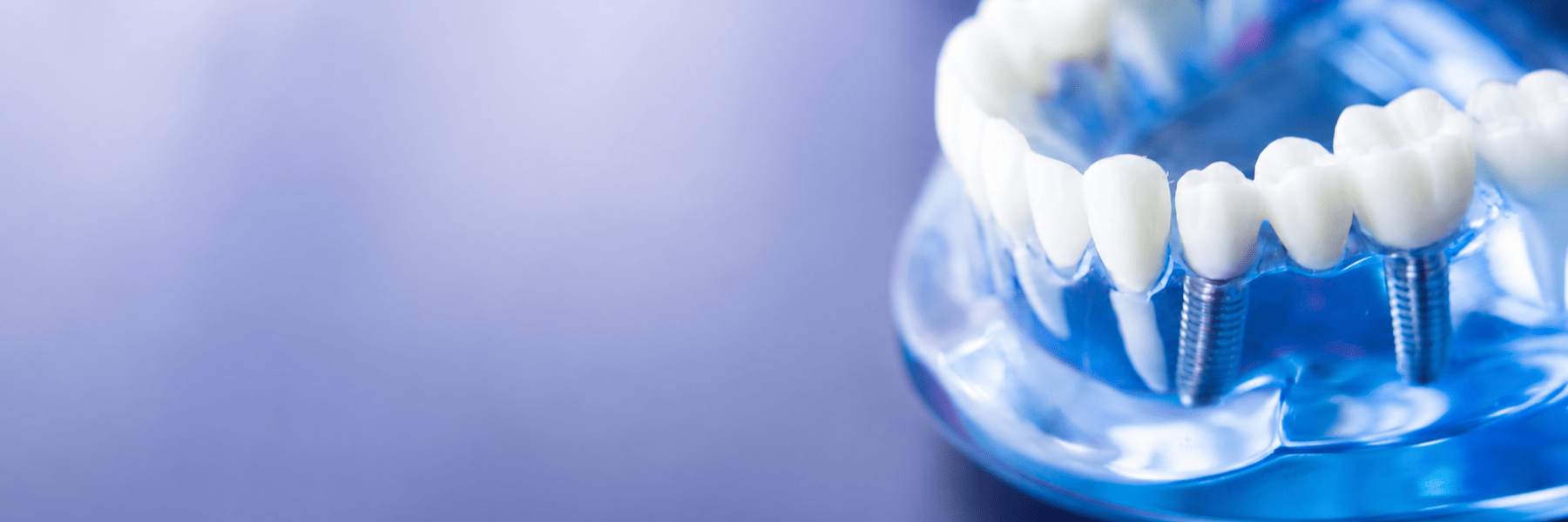 Dental Implants | Dentist