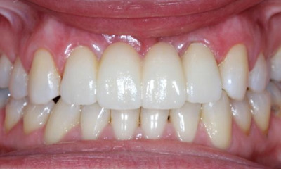 After treatment - Anterior Bridge 