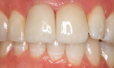 After treatment - Anterior Multiunit