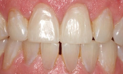 After treatment - Anterior Multiunit