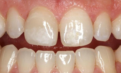 After treatment - Anterior Single Unit
