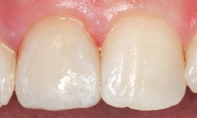 After treatment - Anterior Single Veneer