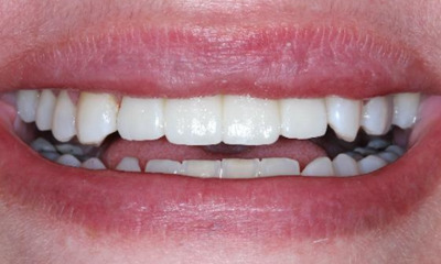 After treatment - Anterior Bridge 