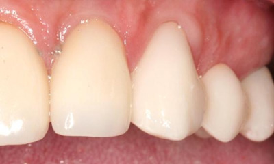 After treatment - Dental Bridge