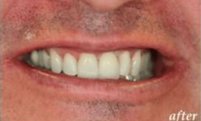 After treatment - Front Implant – Tooth Required Extraction and Implant Placed
