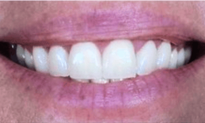 After treatment - Full Mouth Reconstruction with Gum Surgery