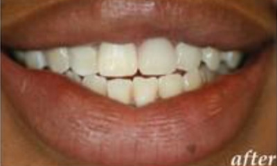 After treatment - New Upper Partial with Tissue Re-contouring and Correct Partial Placement