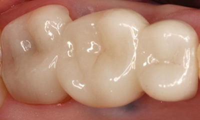 After treatment - Posterior Bridge