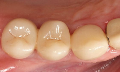 After treatment - Posterior Implant Cement Retained