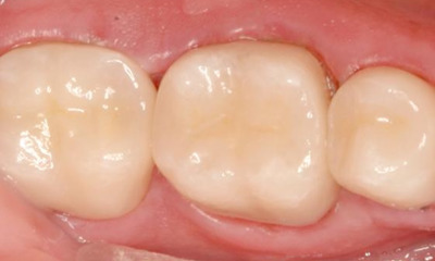 After treatment - Posterior Quadrant