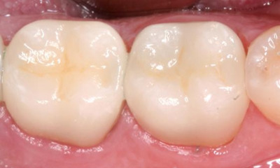 After treatment - Posterior Quadrant