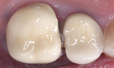 After treatment - Single Posterior Crown
