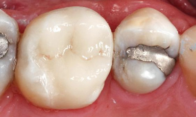 After treatment - Single Posterior Partial Coverage