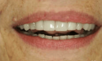 After treatment - Upper Anterior Crowns