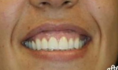 After treatment - Veneer and Crown Combination with Tissue Re-Contouring