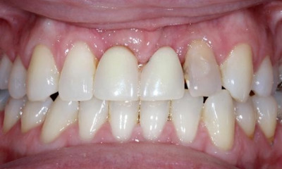 Before treatment - Anterior Bridge 