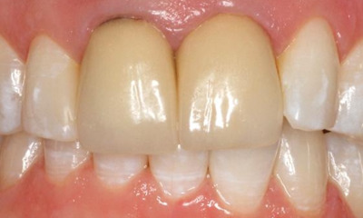 Before treatment - Anterior Multiunit
