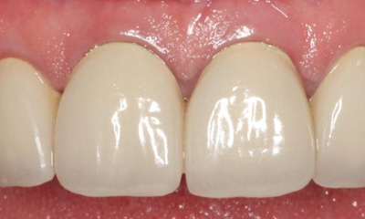 Before treatment - Anterior Multiunit