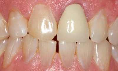 Before treatment - Anterior Multiunit