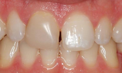 Before treatment - Anterior Single Unit