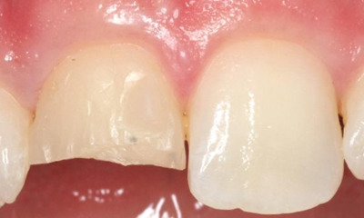 Before treatment - Anterior Single Veneer