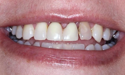 Before treatment - Anterior Bridge 