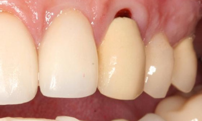 Before treatment - Dental Bridge
