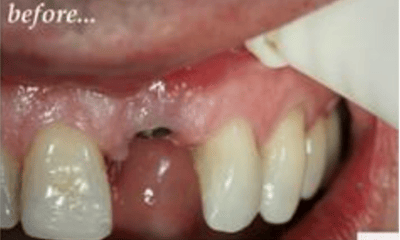 Before treatment - Front Implant – Tooth Required Extraction and Implant Placed