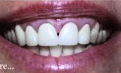 Before treatment - Full Mouth Reconstruction with Gum Surgery