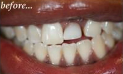 Before treatment - New Upper Partial with Tissue Re-contouring and Correct Partial Placement