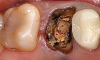 Before treatment - Posterior Bridge
