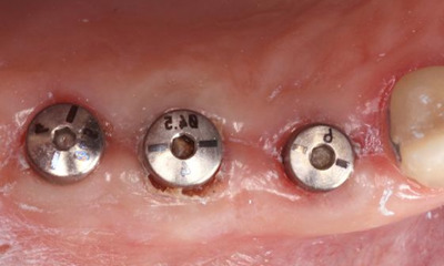 Before treatment - Posterior Implant Cement Retained