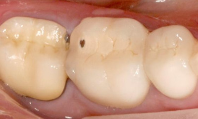 Before treatment - Posterior Quadrant