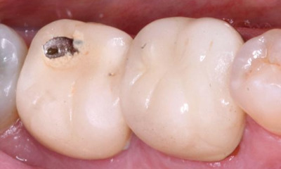 Before treatment - Posterior Quadrant