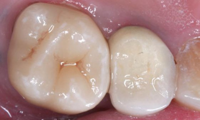 Before treatment - Single Posterior Crown