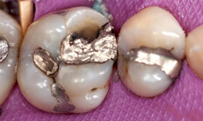 Before treatment - Single Posterior Partial Coverage