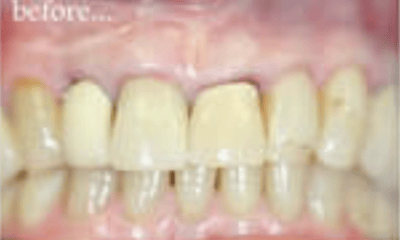 Before treatment - Upper Anterior Crowns