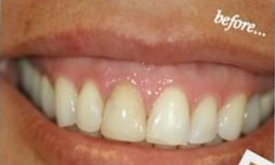 Before treatment - Veneer and Crown Combination with Tissue Re-Contouring