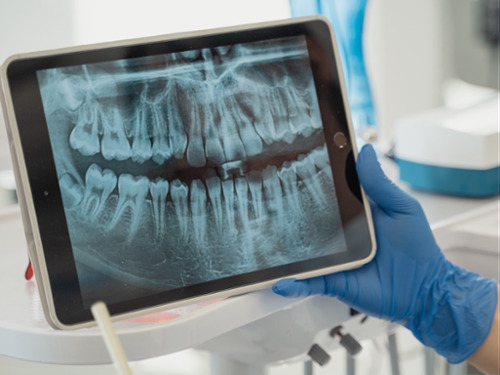 Panoramic X-Rays