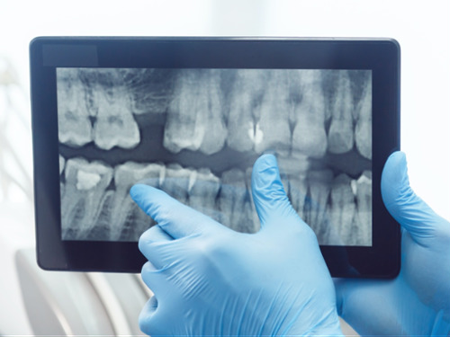 Digital X-Rays & Sensors
