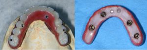 implant dentures