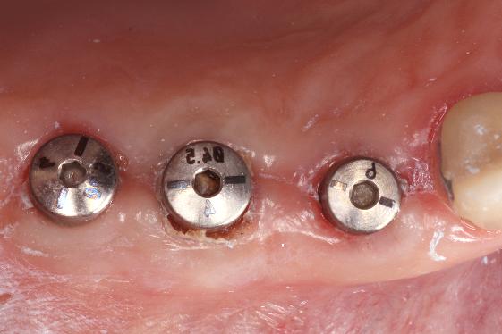 posterior implant cement retained before
