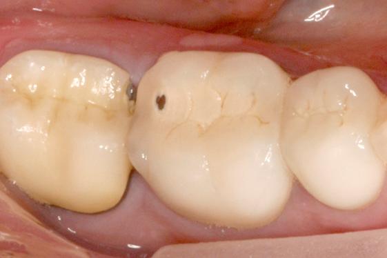 posterior quadrant before