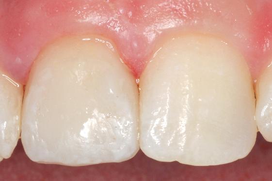 anterior single veneer after