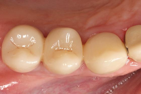 posterior implant cement retained after