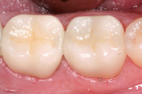 posterior quadrant after