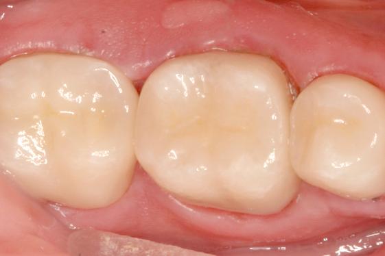 posterior quadrant after