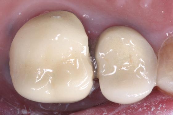 single posterior crown case 1 after