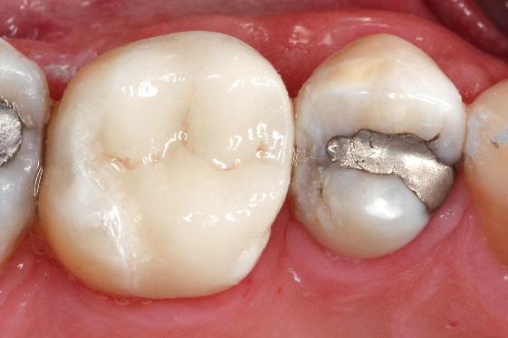 amalgram fillings