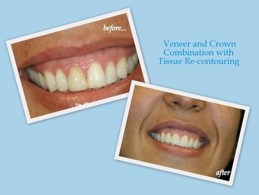 veneer and crown combination with tissue re-contouring